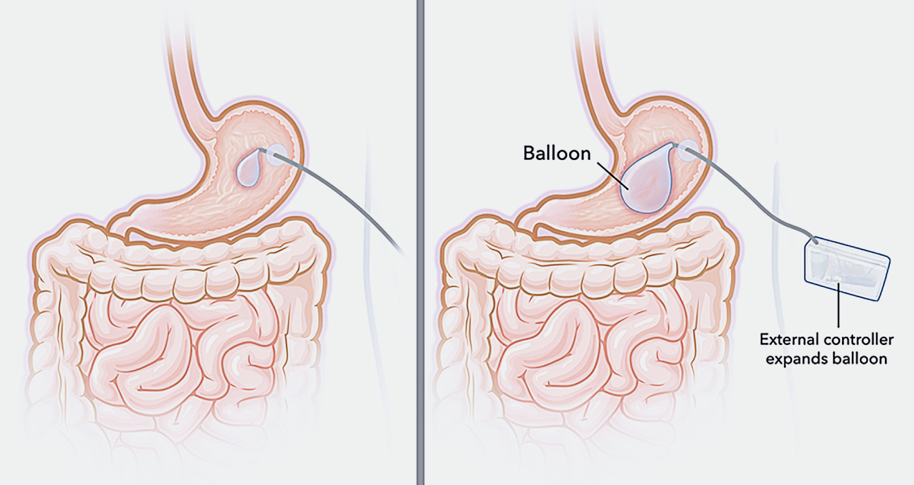 Über eine Außensteuerung wird der Magen-Ballon aufgeblasen oder entleert (© Courtesy of MIT researchers)