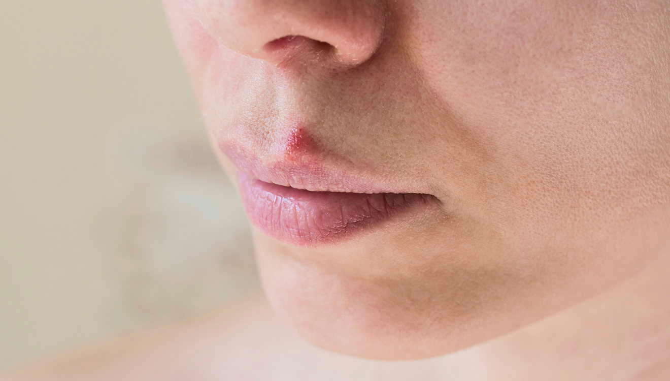 Die medikamentöse Behandlung von Herpes simplex kann sich langfristig auszahlen – in dem sie das Demenz-Risiko senkt
